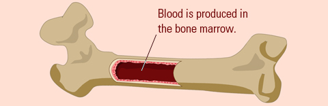 bone marrow transplant for sickle cell anemia